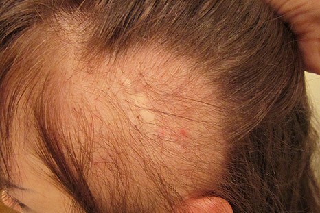 Коррекция линии роста волос в лобно-височных и заушных областях после пластических операций