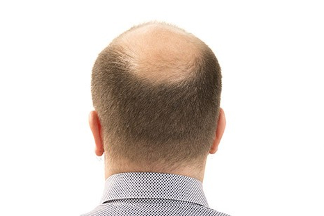 Трансплантация волос при мужском типе потери волос