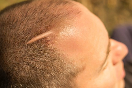 Трансплантация волос в рубцовую ткань (ожоги, травмы)